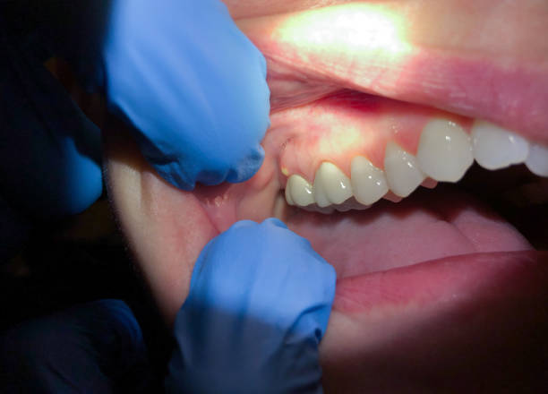 Best Emergency Dental Care for Broken or Chipped Teeth in South Hempstead, NY
